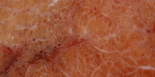 Graves' Disease: Symptoms, Treatment And Complications