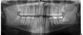 TMJ Dysfunction: Stop Grinding Your Teeth!