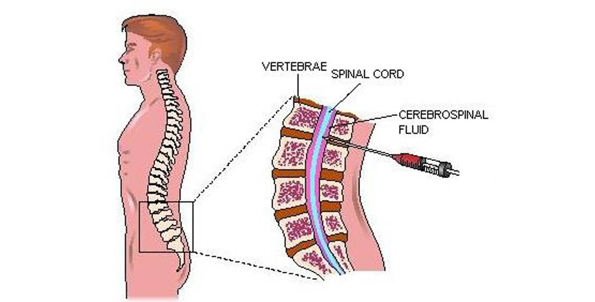 Guillain-Barre Syndrome: Causes, Symptoms & Treatment | Nervous System Disorders and Diseases ...