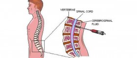 Guillain-Barre Syndrome: Causes, Symptoms & Treatment