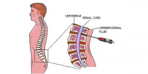 Guillain-Barre Syndrome: Causes, Symptoms & Treatment
