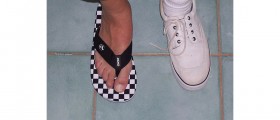 Hammer toe surgery