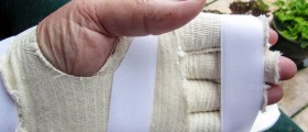 Hand Splints May Ease Pain for People Suffering Degenerative Arthritis