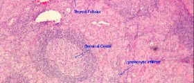 Hashimoto's Disease & Hyperthyroidism