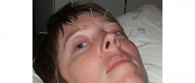 Acupuncture for Bell's Palsy