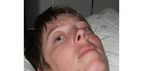 Acupuncture for Bell's Palsy