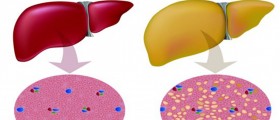 Fatty Liver: Treatment for Fat Accumulation in Liver Cells