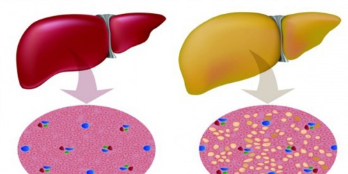 Fatty Liver: Treatment for Fat Accumulation in Liver Cells