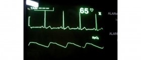 Supraventricular tachycardia: Long term side effects