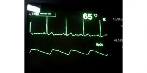 Supraventricular tachycardia: Long term side effects