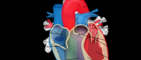 Aortic Arch: Pros and Cons of Aneurysm Surgery