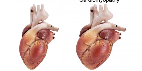 Cardiomyopathy