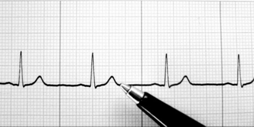 Supraventricular Tachycardia: Diagnosis & Therapy