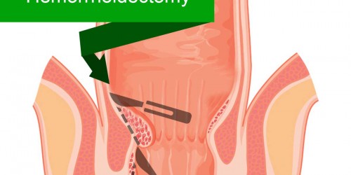 Hemorrhoidectomy: Preparation and Recovery
