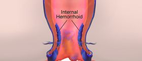 Hemorrhoids: A Pain In The Butt