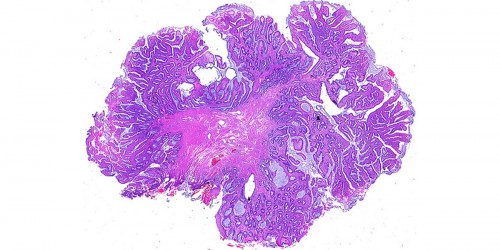 Home Treatments For Hemorrhoids