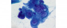 Home Remedies for Genital Herpes