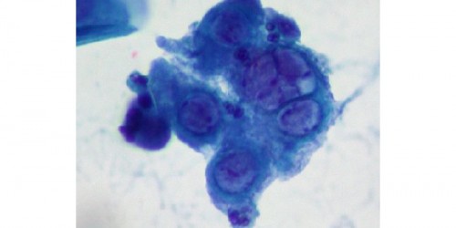 Home Remedies for Genital Herpes