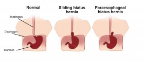 Hiatal hernia
