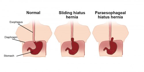 Hiatal hernia