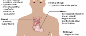 Signs and Symptoms of High Blood Pressure
