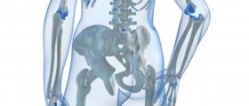 Hip Avascular Necrosis