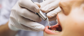 How Long Can A Tooth Survive After A Root Canal Treatment?