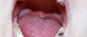 The Changing Face of Oral Cancer