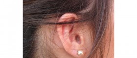 Stapedectomy for Otosclerosis