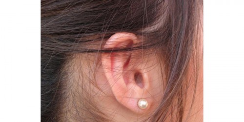 Stapedectomy for Otosclerosis