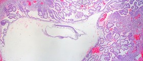Conceiving After A Tubal Ectopic Pregnancy