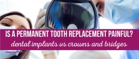 Is A Permanent Tooth Replacement Painful? Dental Implants vs Crowns And Bridges