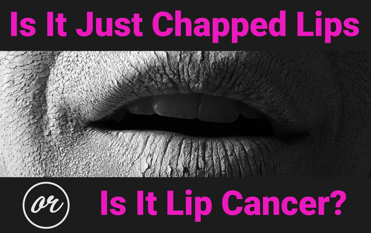 Is It Just Chapped Lips or Is It Lip Cancer (Actinic Cheilitis)? | Ear