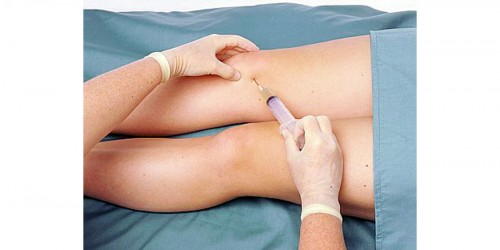 Arthrocentesis - Joint fluid aspiration