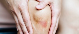 Juvenile Psoriatic Arthritis Overview: Causes, Symptoms, Diagnosis, And Treatment