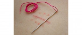 How to Remove Keloid Scars?