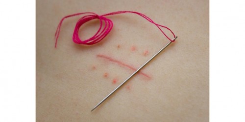 How to Remove Keloid Scars?