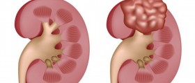 Kidney Cancer - Risks, Symptoms, Treatment, and Prevention Tips