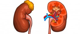 Kidney Problems (Kidney Stones) on a Rise Among Kids