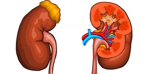 Kidney Problems (Kidney Stones) on a Rise Among Kids