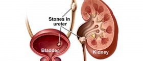 Kidney Stone Flush: Pros and cons