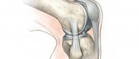 Partial Knee Replacement - Unicompartmental Knee Arthroplasty