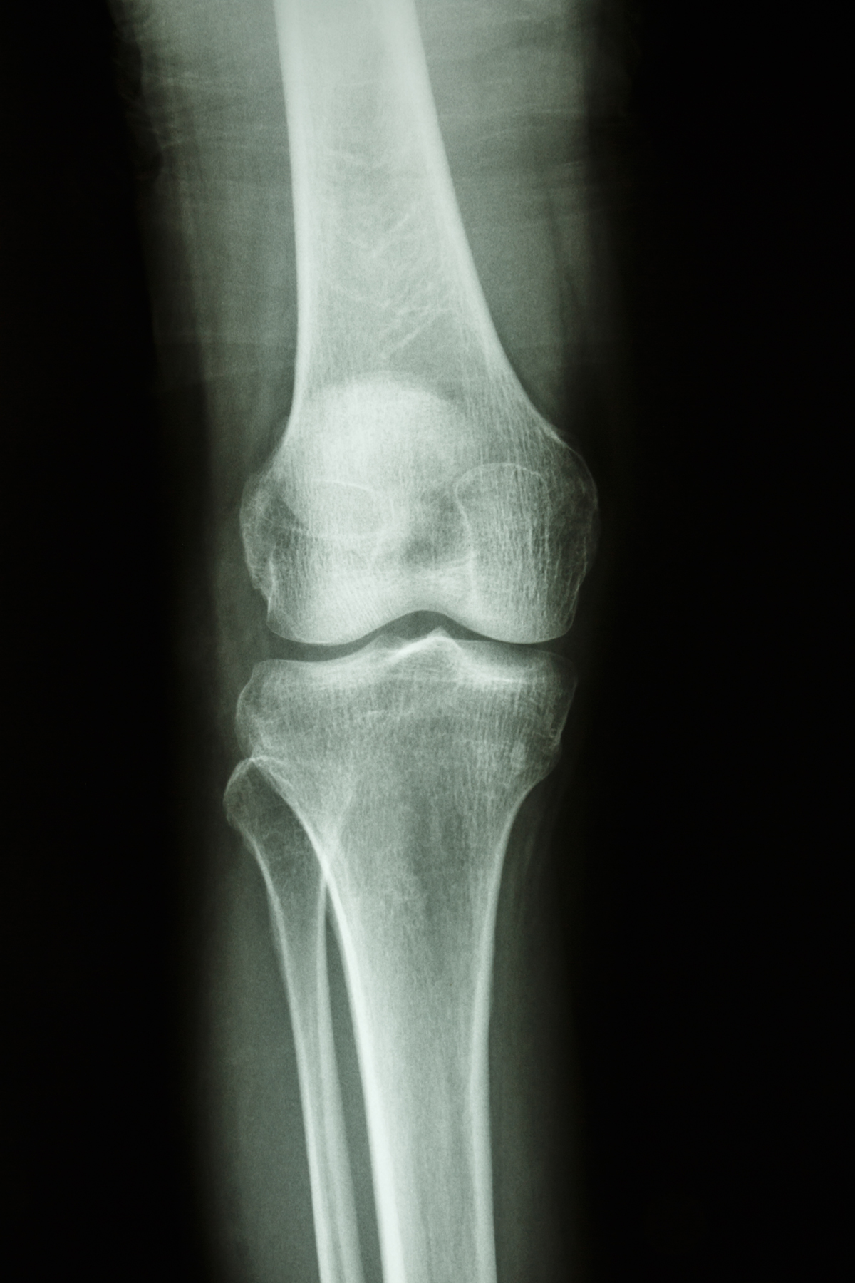 Are Bad Knees in Your Genes? | Healthy Living articles | Well Being