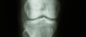 Are Bad Knees in Your Genes?