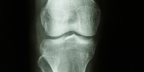 Are Bad Knees in Your Genes?