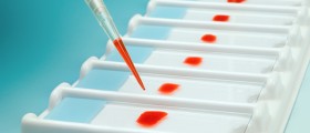 Human Genome Sciences Inc. Won the FDA Approval for the First New Lupus Treatment