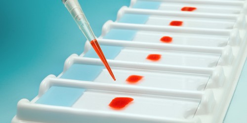 Human Genome Sciences Inc. Won the FDA Approval for the First New Lupus Treatment