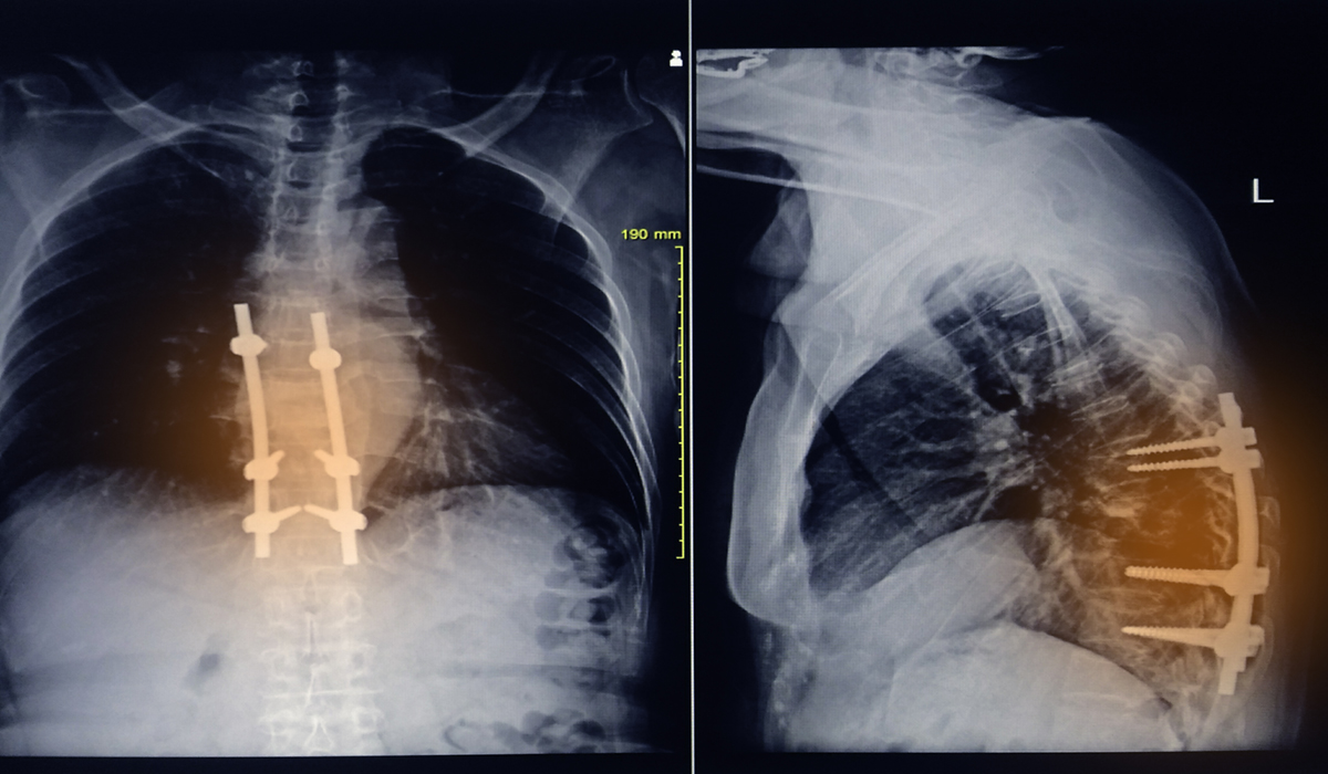 Laminectomy | Musculoskeletal Issues articles | Body & Health