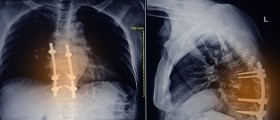 Laminectomy