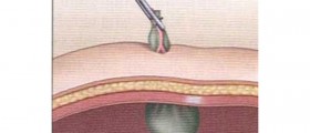 What your doctor forgot to tell you about gallbladder removal